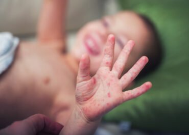 Puluhan Anak di Tasikmalaya Terjangkit Campak, Dinkes Kejar Target Imunisasi Ribuan Balita