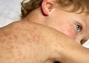 Dokter Tegaskan Tak Ada Istilah “Over Imunisasi”: Vaksin Campak Aman Disuntik Ulang